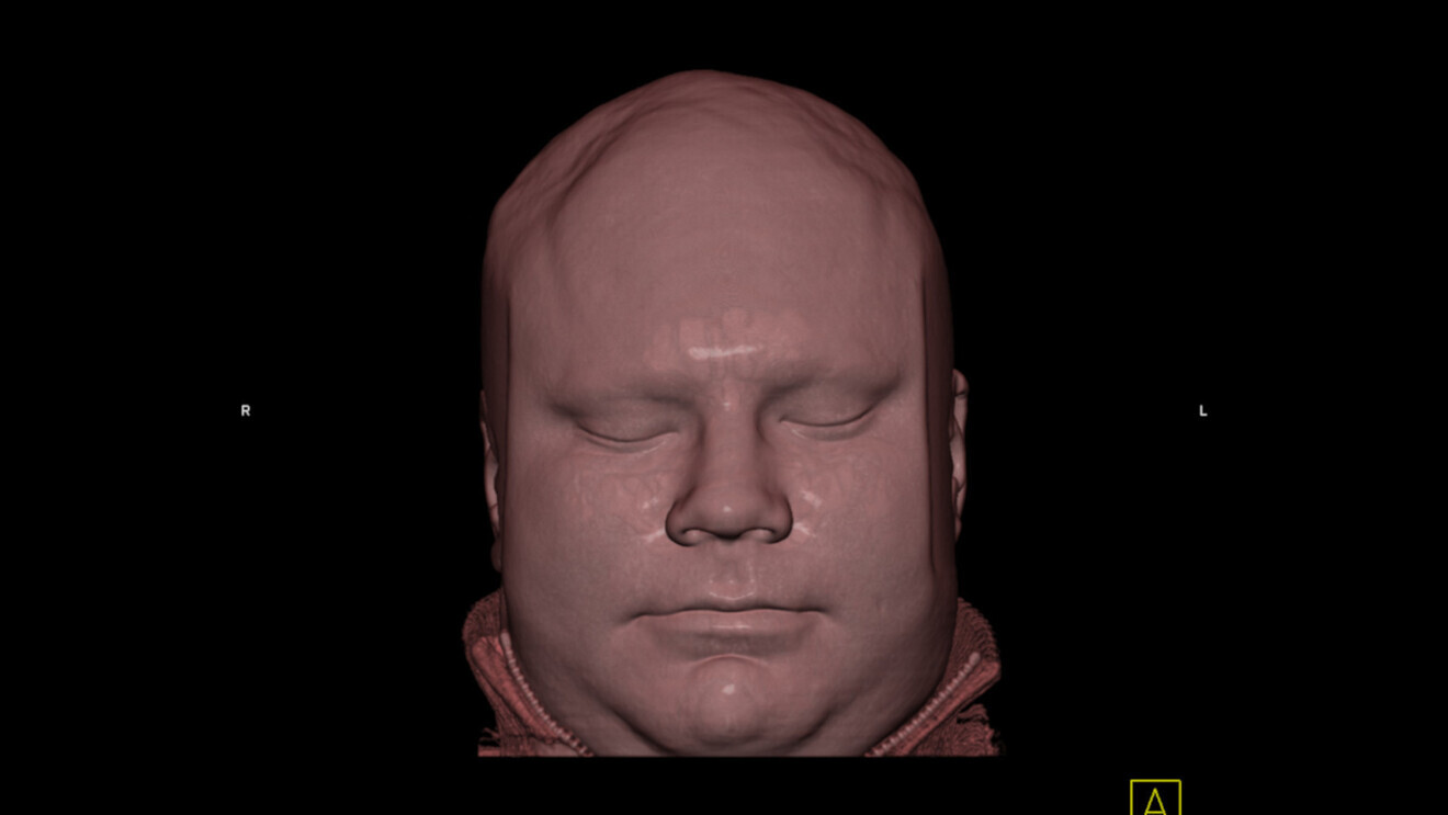 Examples of 3D scans provided by Dr Kustra of his own face. Taken with a Siemens Somatom Sensation Cardiac 64 spiral CT scanner, such images are useful for virtual endoscopy planning. 