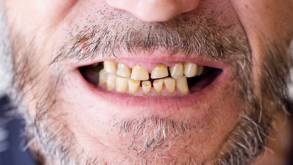 Pandemija povzroča povečanje incidence stresnih pogojev ustnega zdravja