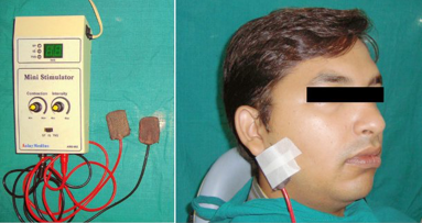 La terapia eléctrica puede aliviar la xerostomía