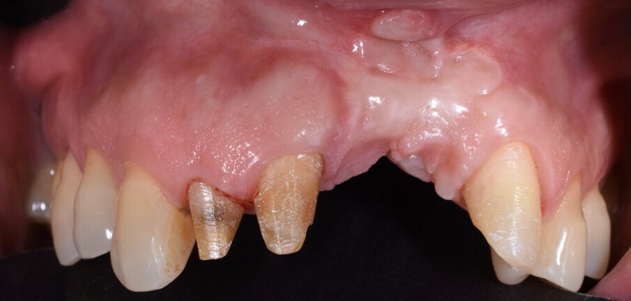 Fig. 12 - Guarigione a 9 mesi.