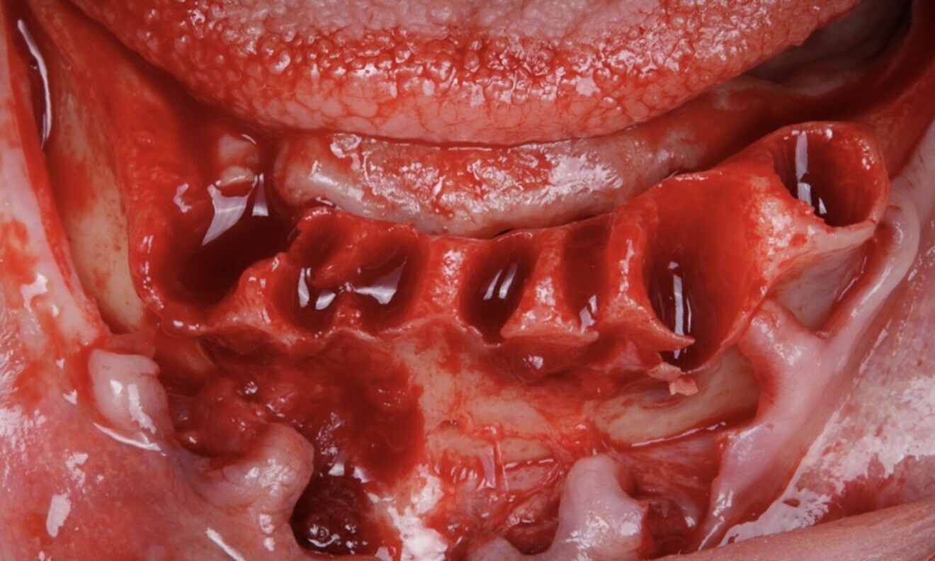 Figs. 34 & 35: After tooth extraction, a full-thickness mucoperiosteal flap was raised for surgical access.