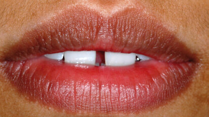 Diastema mediana - zatvaranje korišćenjem direktnih adhezivnih restauracija