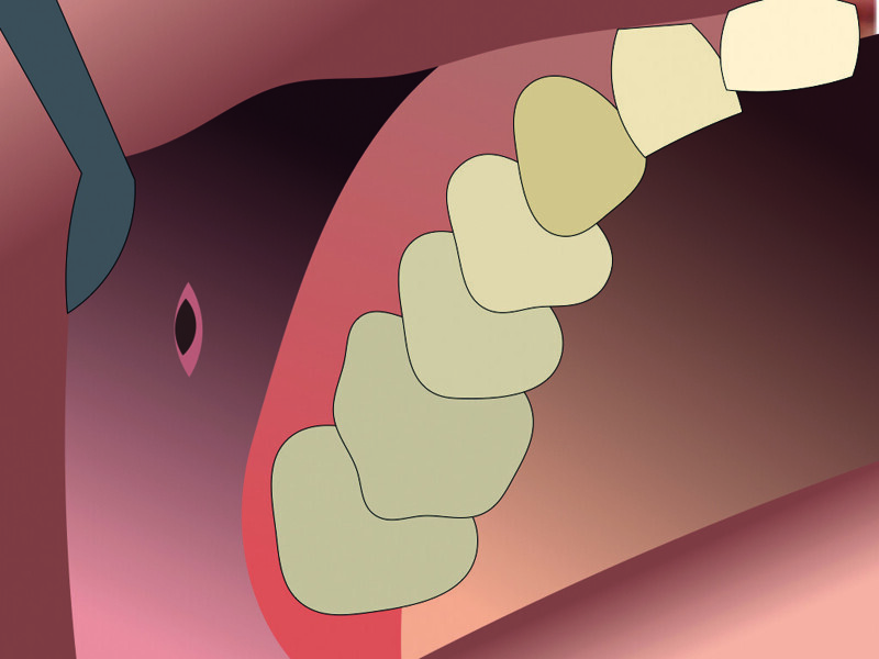 Fig. 10 : Incision au fond du vestibule.