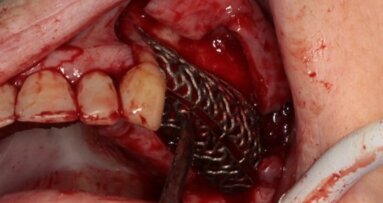 Zastosowanie indywidualnej siatki tytanowej do augmentacji wyrostka zębodołowego szczęki