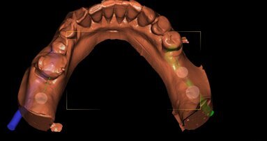 Precyzja zabiegów implantologicznych – badania in vitro z wykorzystaniem druku 3D – cz. 1