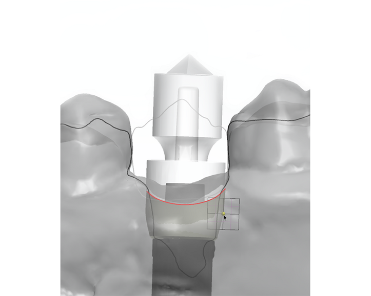 Neoss Digital Workflow with 3Shape