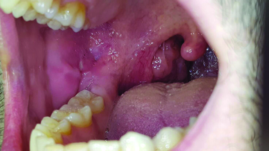 Fig. 1 - L’afta minor nella mucosa buccale destra.