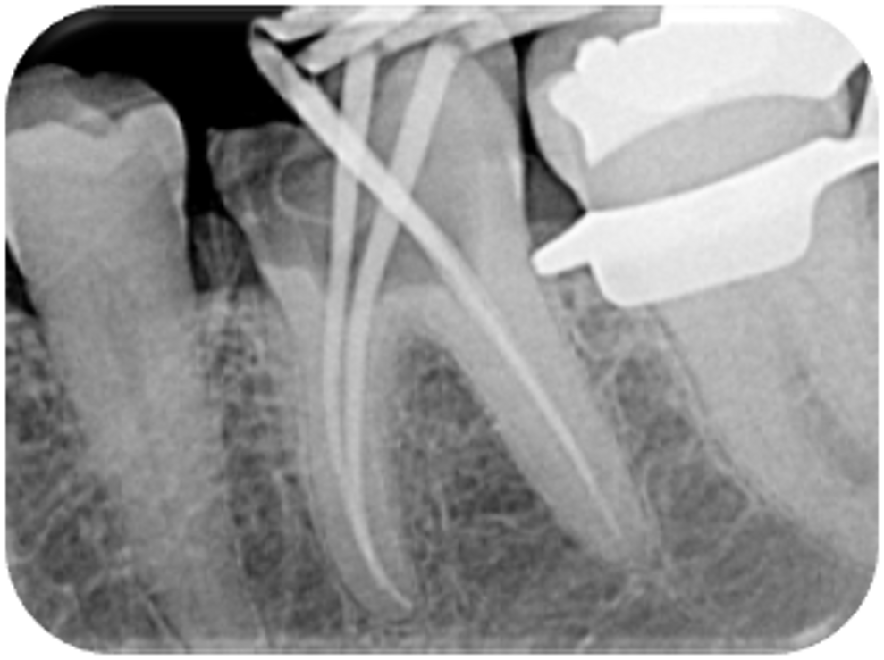 Fig. 5: Master point radiograph. 