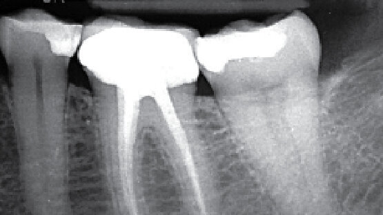 Prípad diagnostikovania až po sprístupnenie