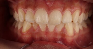 ClearX teen smile transformation