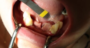 Obwodowy ziarniniak olbrzymiokomórkowy – charakterystyka i opis przypadków