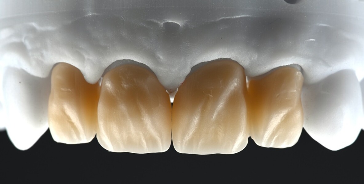 Fig. 3: Restorations on the model after characterisation with colouring liquids and sintering on the model.
