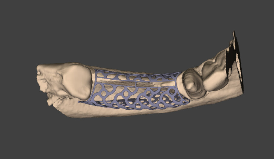 Figg. 2a, 2b_Modello digitale della situazione iniziale con il progetto definitivo della griglia in titanio customizzata Y-Xoss®.