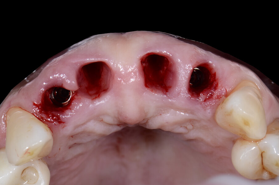 Fig. 31 - Visione occlusale impianti inseriti.