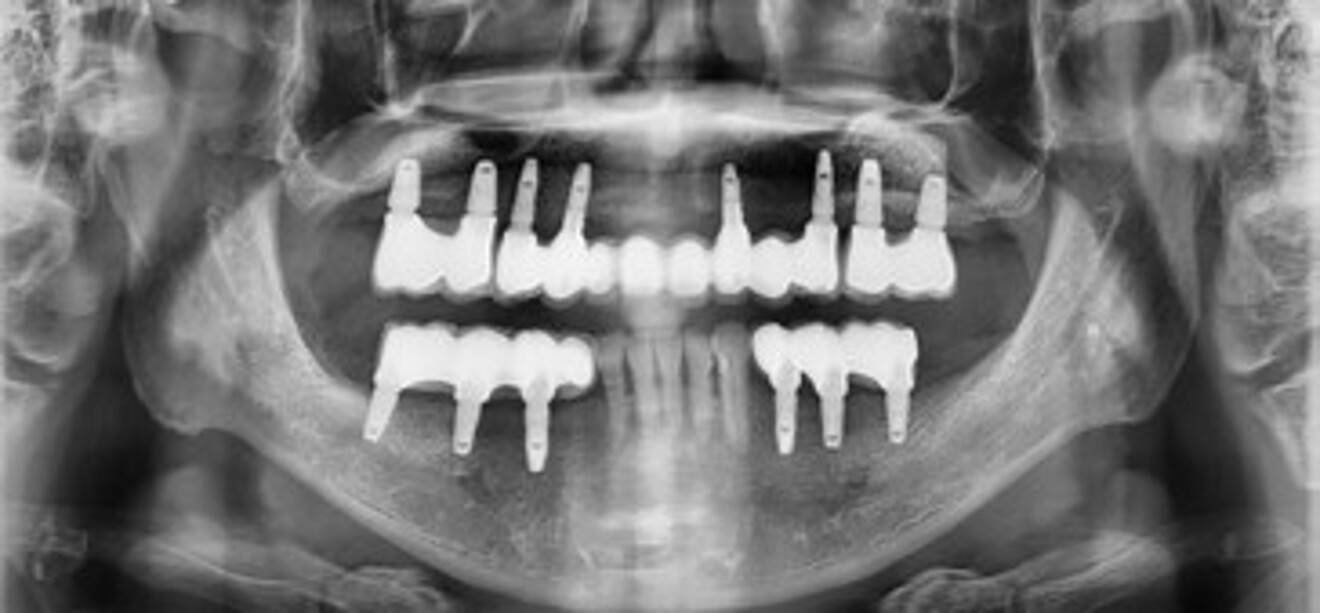 Figs. 4d: Post-treatment panoramic radiographs.