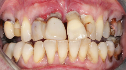 Greffons radiculaires : traitement des défauts osseux antérieurs par racines dentaires ankylosées