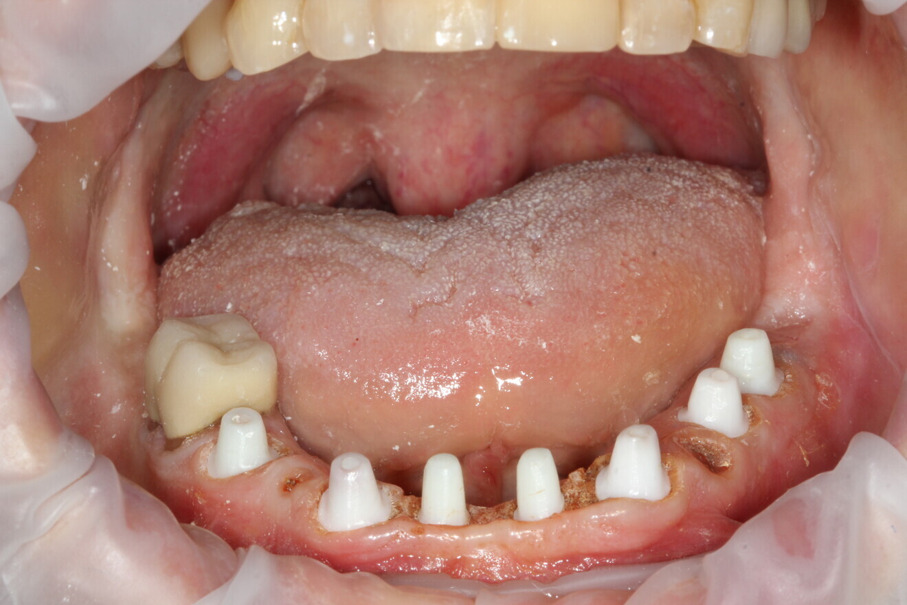 Fig. 12: Prepared and parallelised abutments.