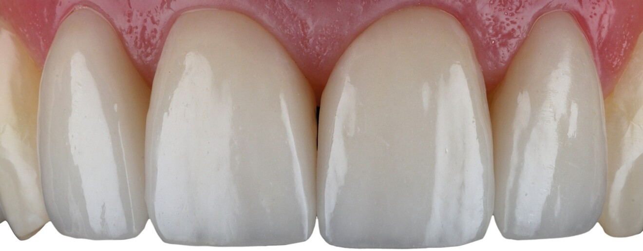 Fig. 23: Follow-up after three weeks showing complete soft-tissue healing, stable marginal integration and healthy gingival contours.