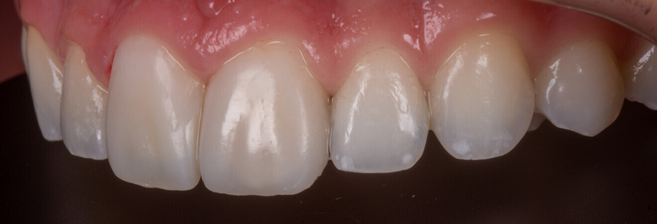 Fig. 26 : Facettes mono-teintes sur 11 et 21.