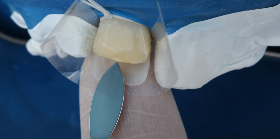 Fig 3: Useful for making a free hand palatal shell