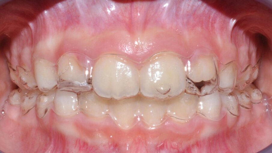 Fig. 7_Fotografie occlusali frontali che mostrano i T guide.