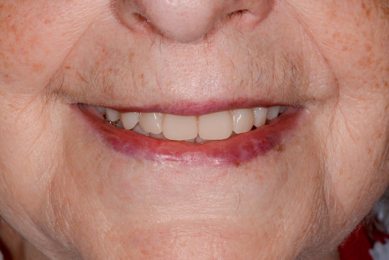 Fig. 23: Definitive complete dentures in situ, frontal view.