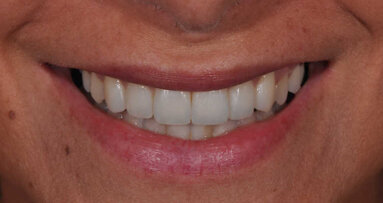 Questions de forme : modifications conservatrices des contours et contacts dentaires