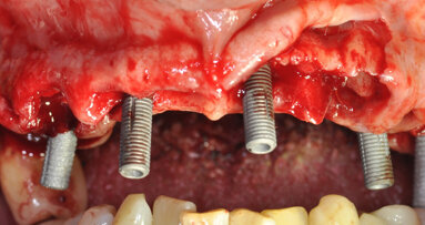 La protesi fissa a carico immediato con tecnica Flat-One-Bridge: uno studio retrospettivo a 7 anni