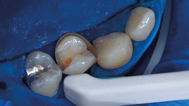 Case report. Restauro eseguito utilizzando le matrici Pro-Matrix e il composito Enamel Plus HRi