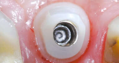 Gestione di una monoedentulia in area estetica in presenza di esostosi vestibolare: caso clinico