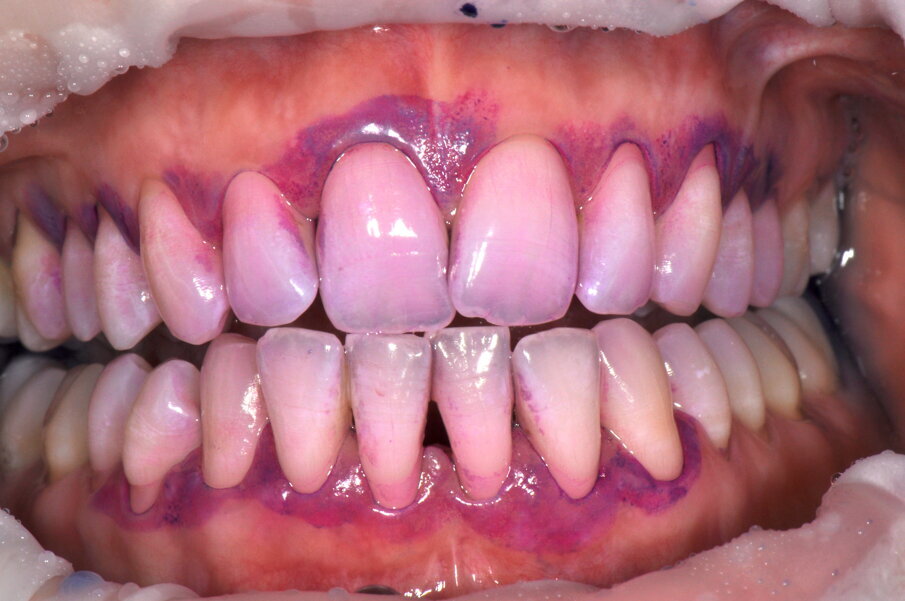 Figg. 6a-6d - Confronto fra stato iniziale e alla valutazione a 2 settimane (6a, 6c), il rilevatore di placca (6b, 6d) mostra chiaramente il miglioramento della compliance del paziente.