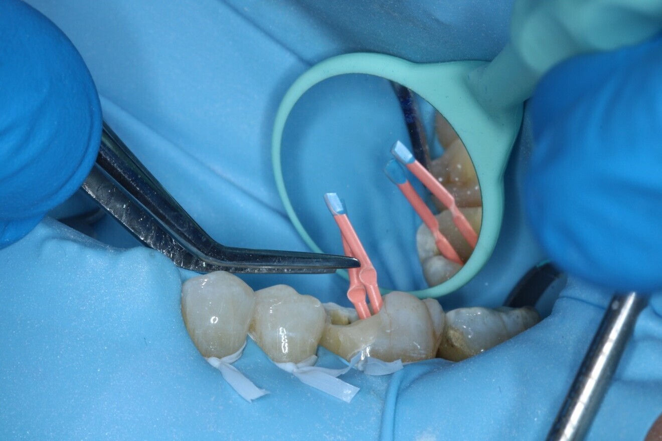Fig. 12: Placement of Hyflex EDM gutta-percha master points to working length.