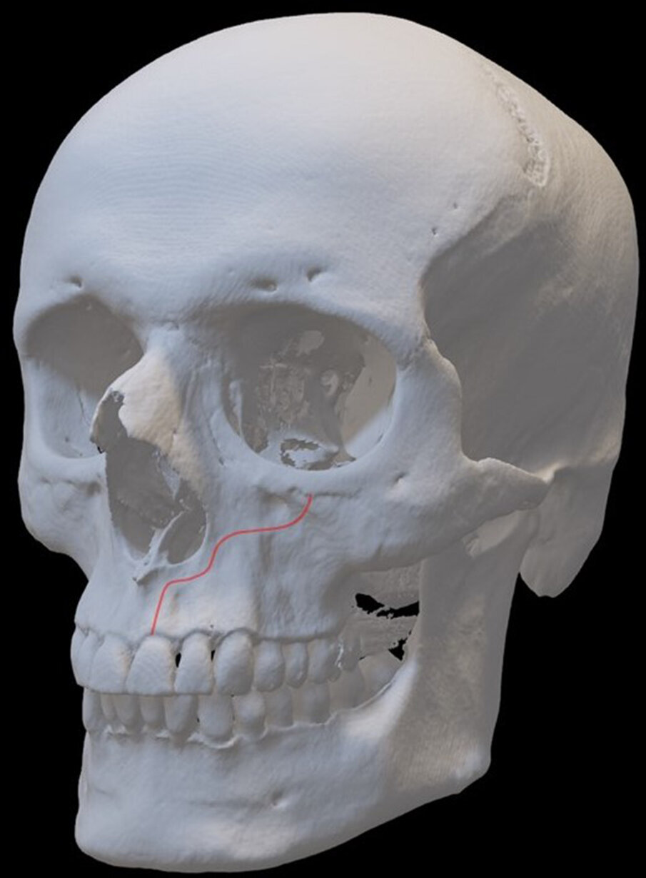 Fig. 1 - Decorso del CS simulato in un volume (rendering).