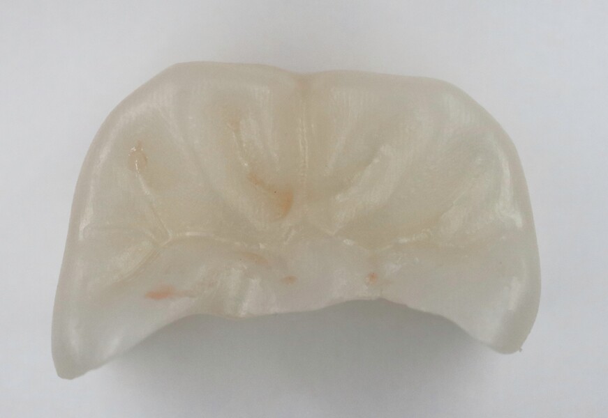 Fig. 16a: Milled zirconia pinlay: occlusal view. 