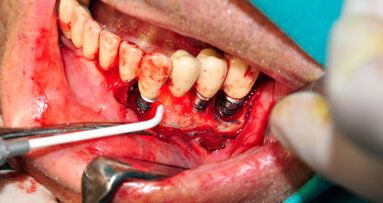 Photodynamic therapy: Indispensable adjunct for disinfecting immediate restorations