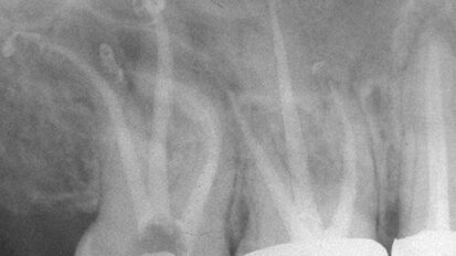 Is rotary NiTi the new paradigm?