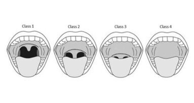 Trattamento dei disturbi del sonno con Laser Er:YAG Fotona