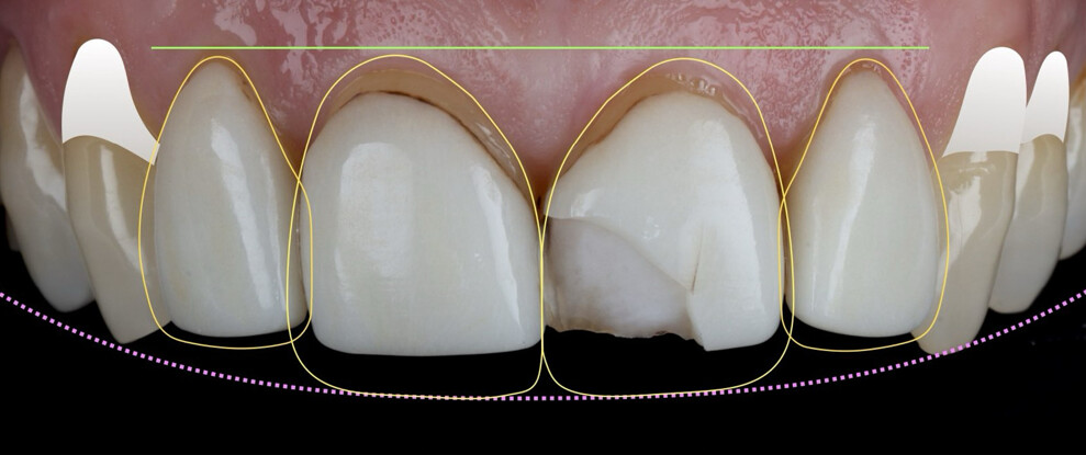 Fig. 2: Treatment planning using digital smile design, including four porcelain veneers and four direct composite restorations.