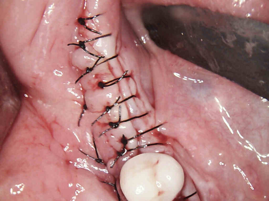 Figg. 13, 14_Viene eseguito il posizionamento degli impianti e la sutura.