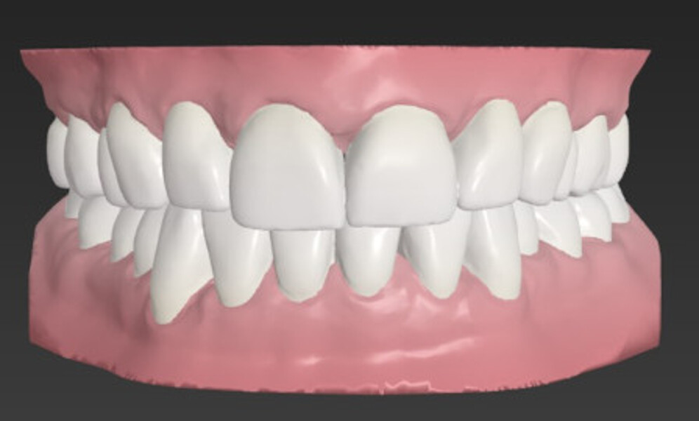 Fig. 7: ClearCorrect refinement set-up for three steps of aligner treatment.