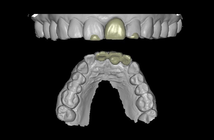 Fig. 20_Corona provvisoria realizzata con coDiagnostiX (Dental Wings).