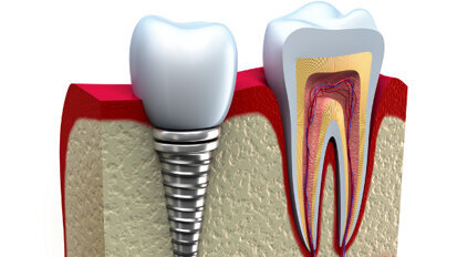 De l´intérêt des modifications de surface sur les implants en titane