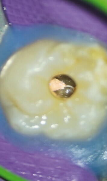 Figs. 8a-c : Entrées des canaux radiculaires obturées et plancher de la cavité pulpaire nettoyé. (a) Vue palatine, (b) vue mésio-vestibulaire et (c) vue disto-vestibulaire. 