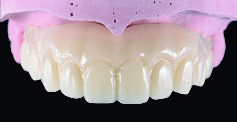 Fig 11. Milled Full-contour PMMA bridge 