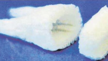 Το  πανεπιστήμιο Columbia ανακοινώνει καινοτομίες στην οδοντική ανάπλαση. Σκελετός από βλαστοκύτταρα μπορεί δυνητικά να αντικαταστήσει τα οδοντικά εμφυτεύματα