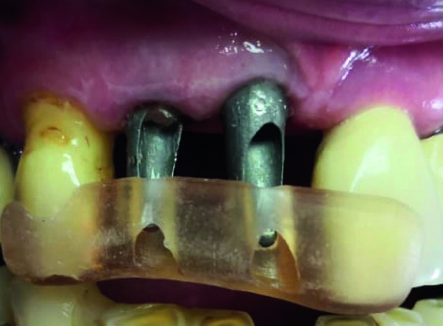 Fig. 16 : Mise en place des piliers à l’aide d’une clé de repositionnement. 
