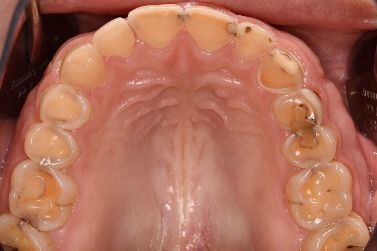 Fig. 1d: Almost complete loss of the occlusal relief in the upper jaw.