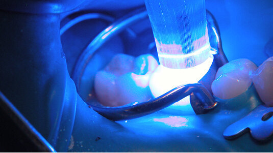 Studie případu řešeného kompozitním materiálem typu bulk-fill: Fill-Up! od COLTENE