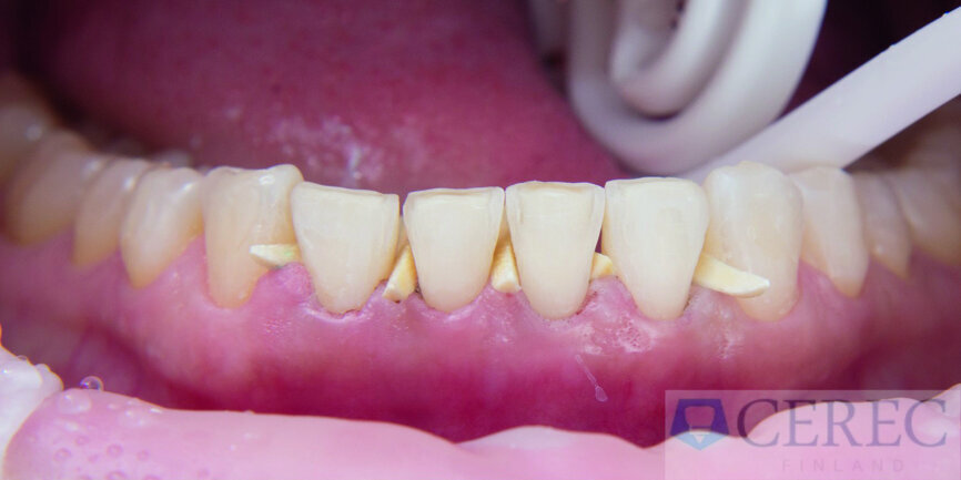 Fig. 7: Preparing the mandible for the veneers.