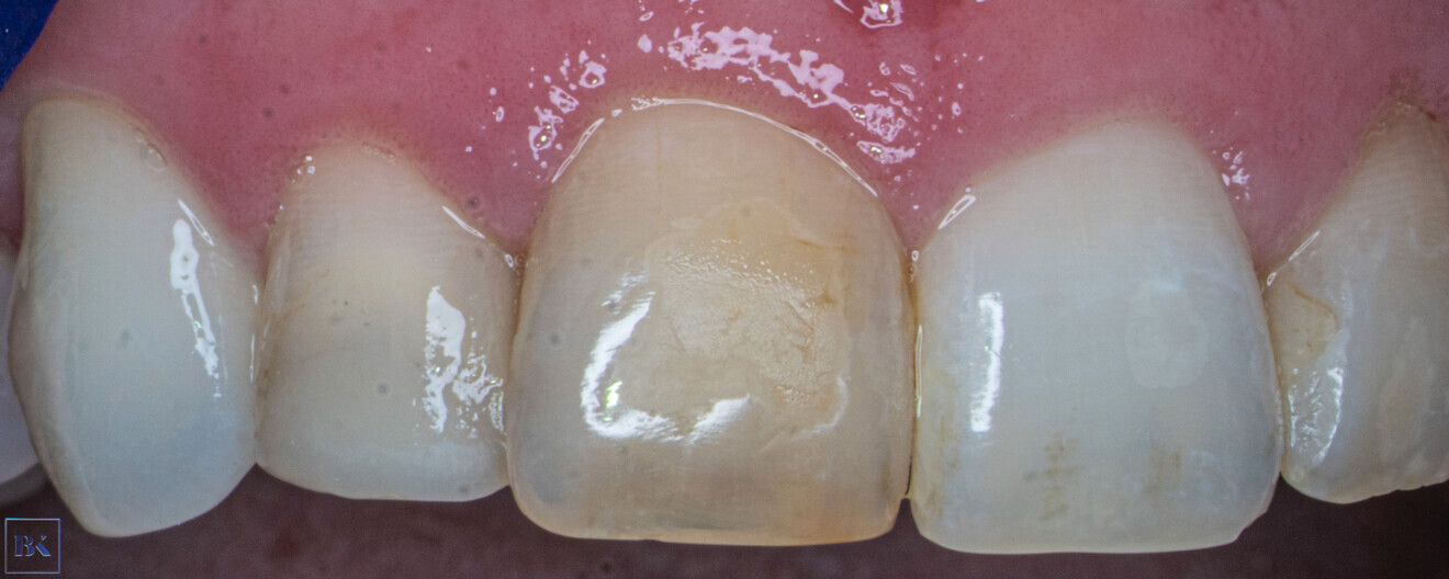 Fig. 1: Intra-oral view of the initial situation. Visible discoloration of the right central incisor.